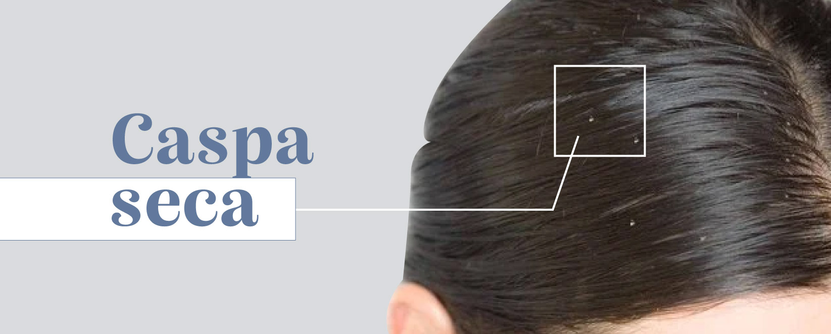 Tipos de caspa: ¿Cómo identificarlas y qué hacer con cada una? - Blog ...